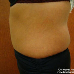 Tummy Tuck before and after photos