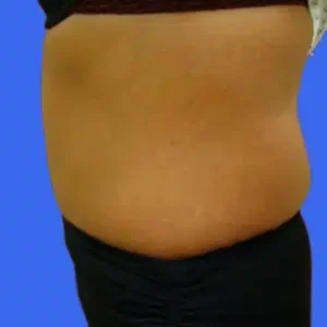 Tummy Tuck before and after photos Tummy Tuck before and after photos