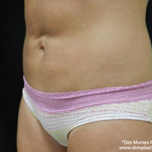 CoolSculpting before and after photos