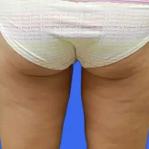 CoolSculpting before and after photos CoolSculpting before and after photos