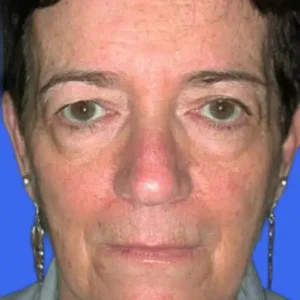 Brow Lift before and after photos