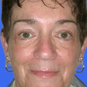 Brow Lift before and after photos