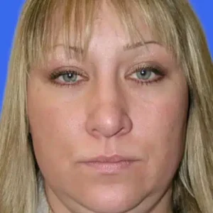 Neck Liposuction before and after photos