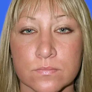 Neck Liposuction before and after photos