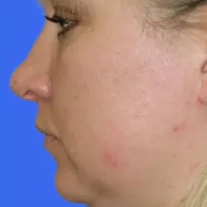 Neck Liposuction before and after photos