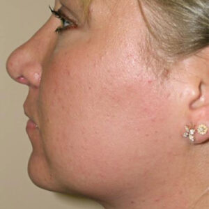 Neck Liposuction before and after photos