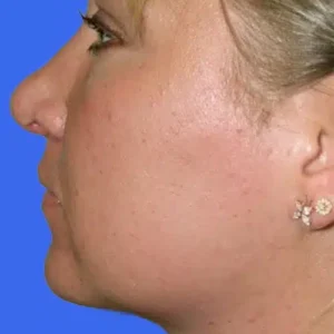 Neck Liposuction before and after photos