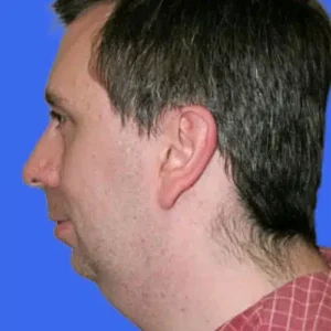 Chin Augmentation before and after photos