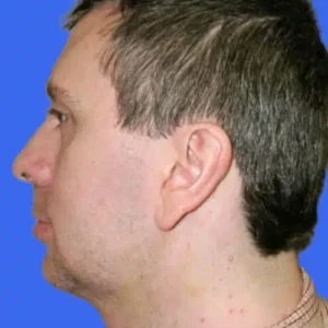 Chin Augmentation before and after photos