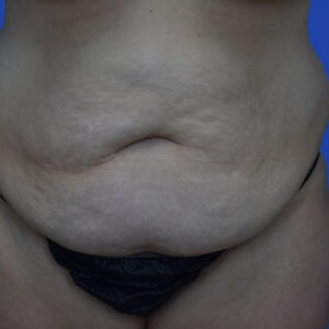 Tummy Tuck before and after photos
