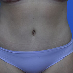 Tummy Tuck before and after photos