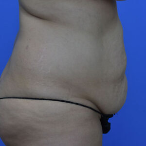 Tummy Tuck before and after photos