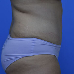 Tummy Tuck before and after photos