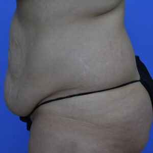 Tummy Tuck before and after photos
