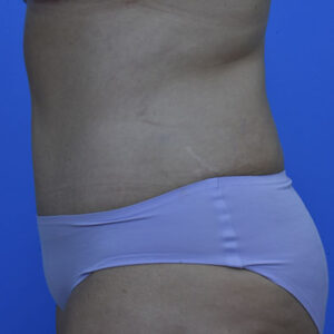 Tummy Tuck before and after photos