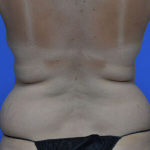 Tummy Tuck before and after photos