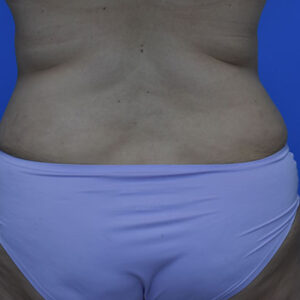 Tummy Tuck before and after photos