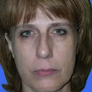 Face Lift before and after photos