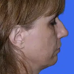 Face Lift before and after photos