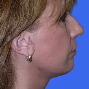 Face Lift before and after photos