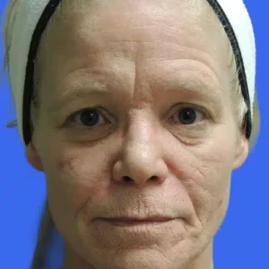 Laser Skin Resurfacing before and after photos