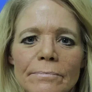 Laser Skin Resurfacing