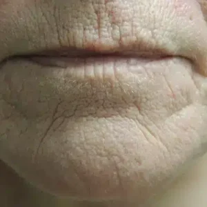 Laser Skin Resurfacing