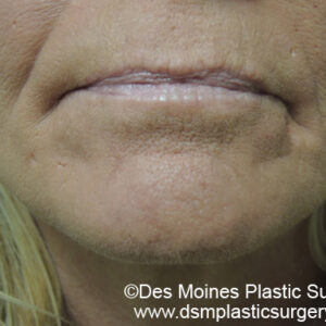 Laser Skin Resurfacing before and after photos