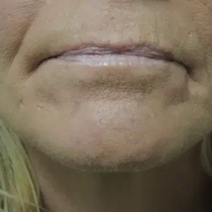 Laser Skin Resurfacing