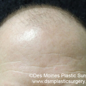 Neograft Hair Loss Replacement before and after photos