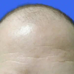 Neograft Hair Loss Replacement before and after photos
