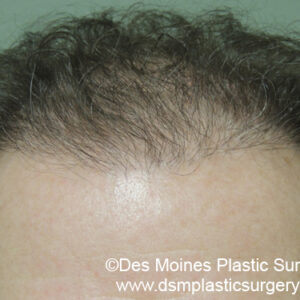 Neograft Hair Loss Replacement before and after photos