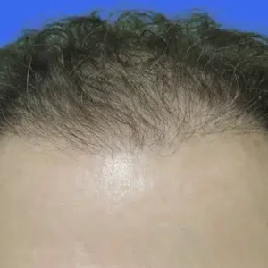 Neograft Hair Loss Replacement before and after photos
