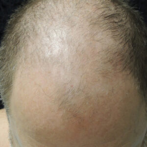 Neograft Hair Loss Replacement before and after photos