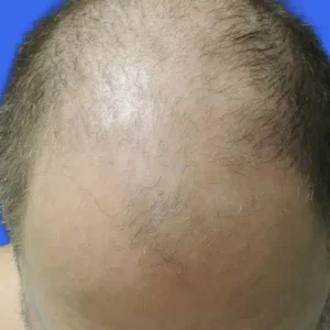 Neograft Hair Loss Replacement before and after photos