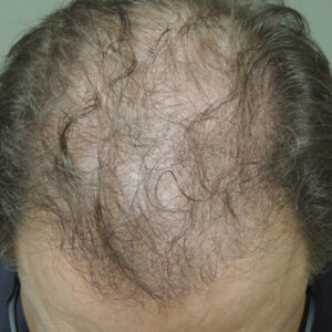 Neograft Hair Loss Replacement before and after photos