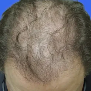 Neograft Hair Loss Replacement before and after photos