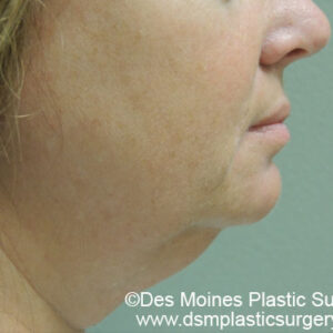 Laser Lift before and after photos