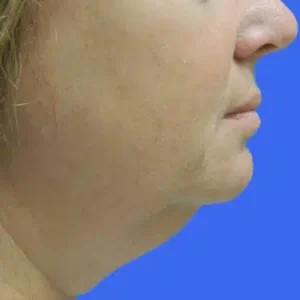 Laser Lift before and after photos