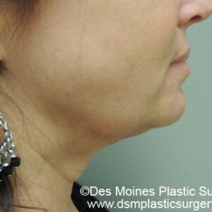Laser Lift before and after photos