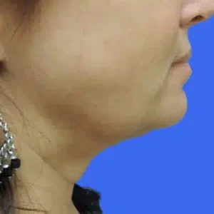 Laser Lift before and after photos