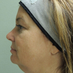 Laser Lift before and after photos