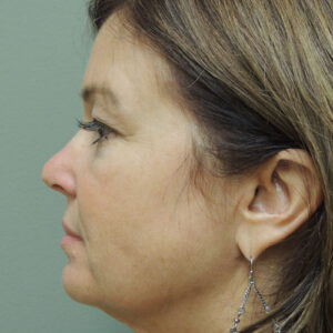 Laser Lift before and after photos