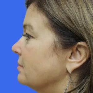 Laser Lift before and after photos