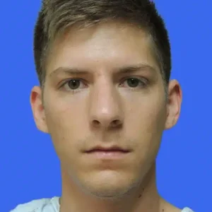 Rhinoplasty before and after photos