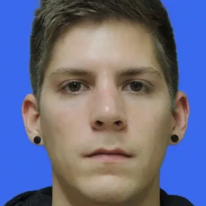 Rhinoplasty before and after photos