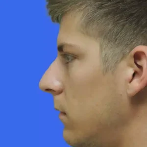 Rhinoplasty before and after photos