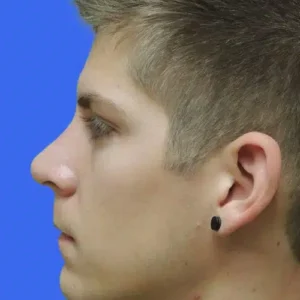 Rhinoplasty before and after photos