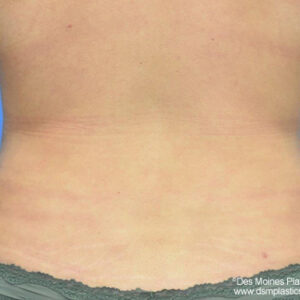 Liposuction before and after photos