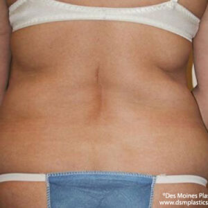 Liposuction before and after photos